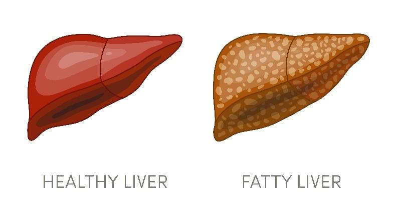 Is There Any Cure for Metabolic dysfunction-Associated Steatohepatitis (Nash)? Is There Any Cure for Metabolic dysfunction-Associated Steatohepatitis (Nash)?